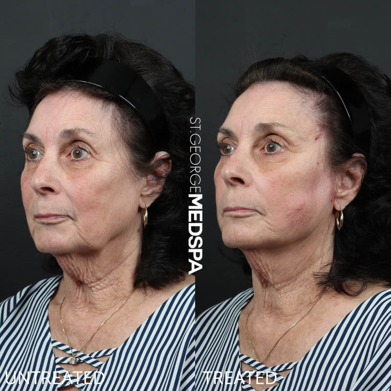 Skin Tightening Thread Before & After Image