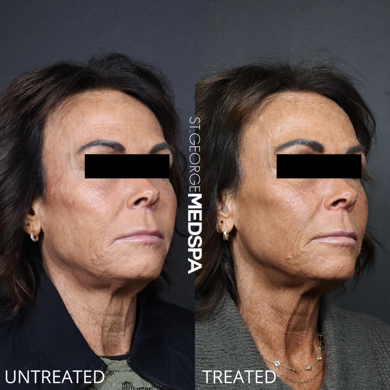 Skin Tightening Thread Before & After Image
