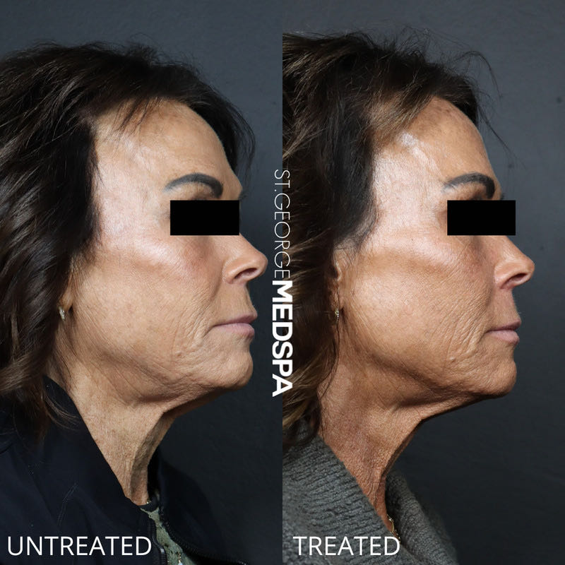 Skin Tightening Thread Before & After Image