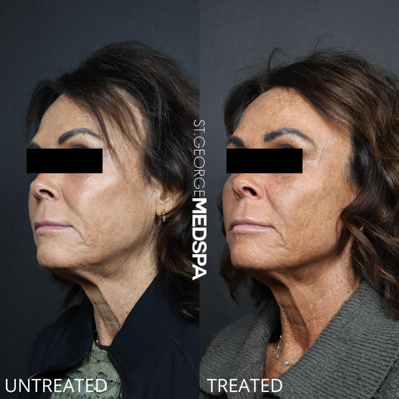 Skin Tightening Thread Before & After Image