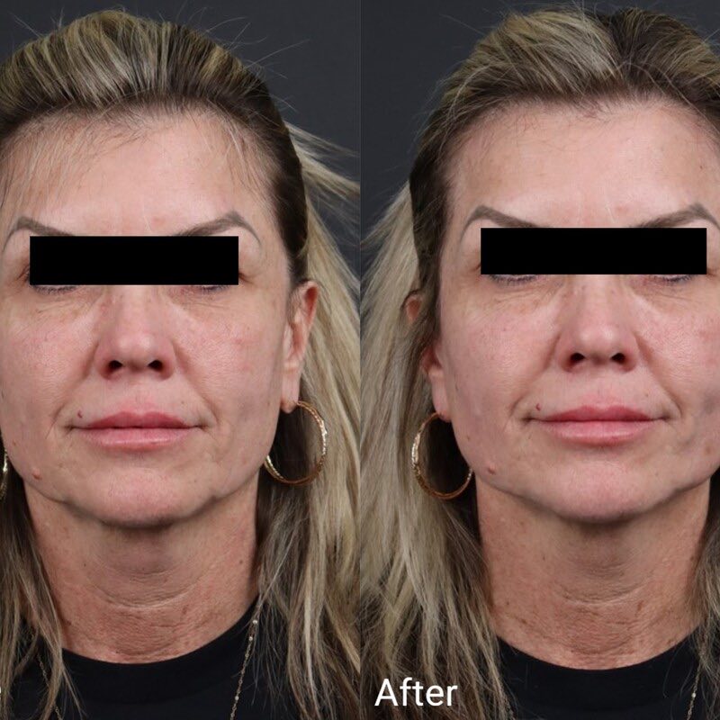 Skin Tightening Thread Before & After Image