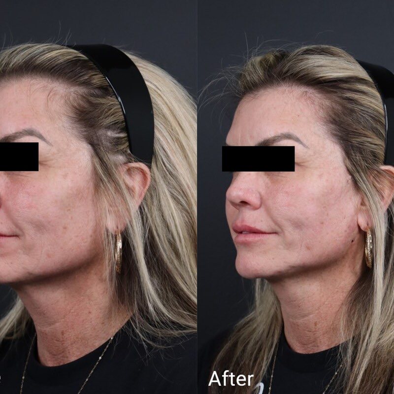 Skin Tightening Thread Before & After Image