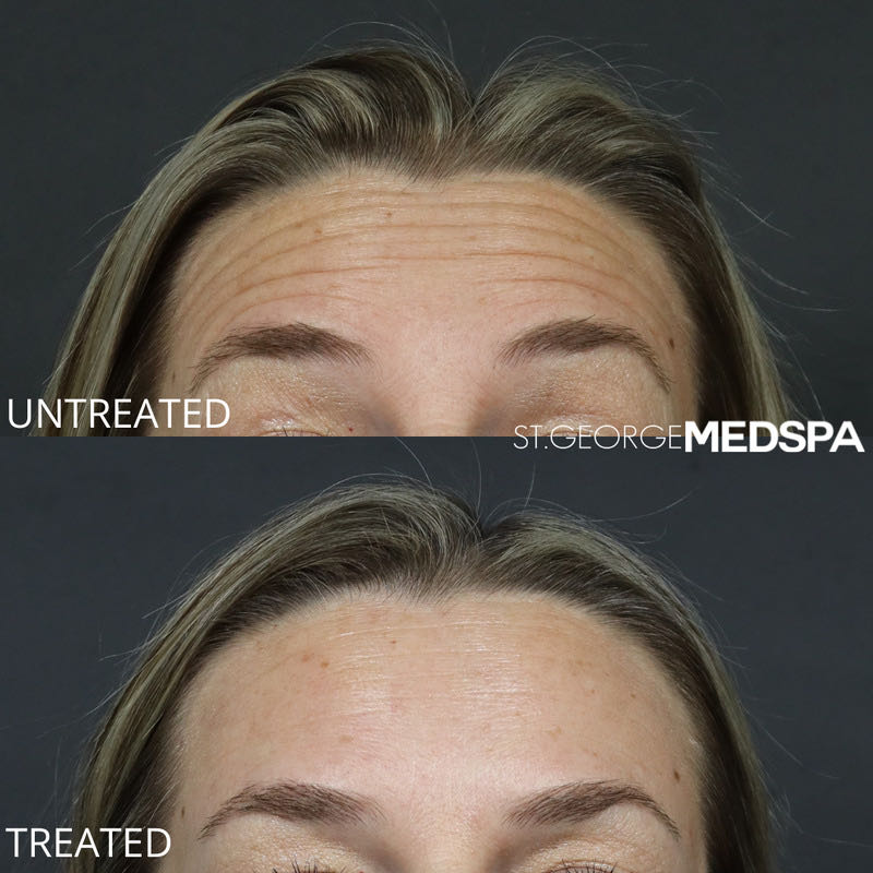 Xeomin Before & After Image