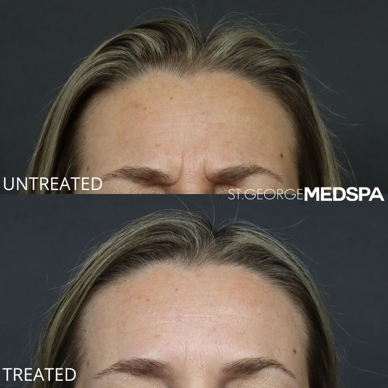 Xeomin Before & After Image