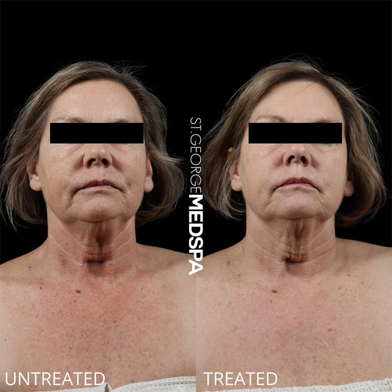 Laser Treatments Before & After Image