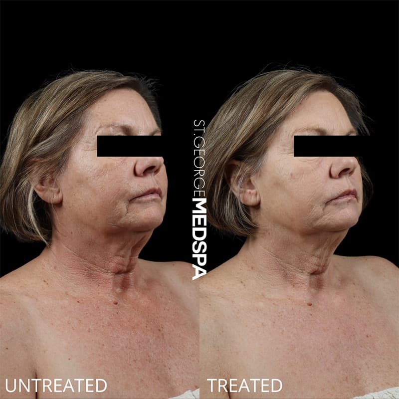 Laser Treatments Before & After Image