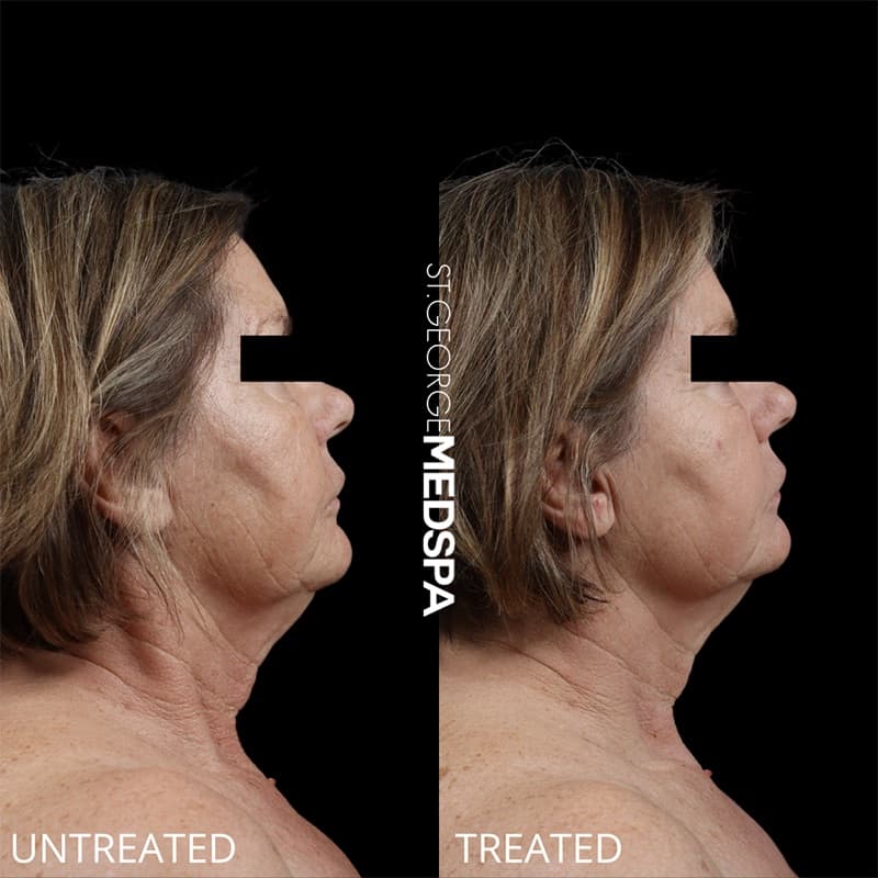 Laser Treatments Before & After Image