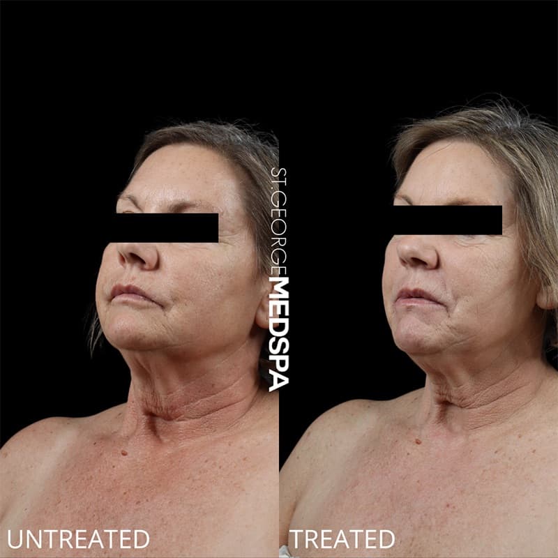 Laser Treatments Before & After Image