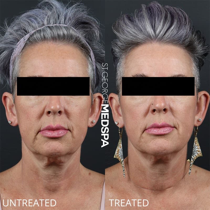 Laser Treatments Before & After Image