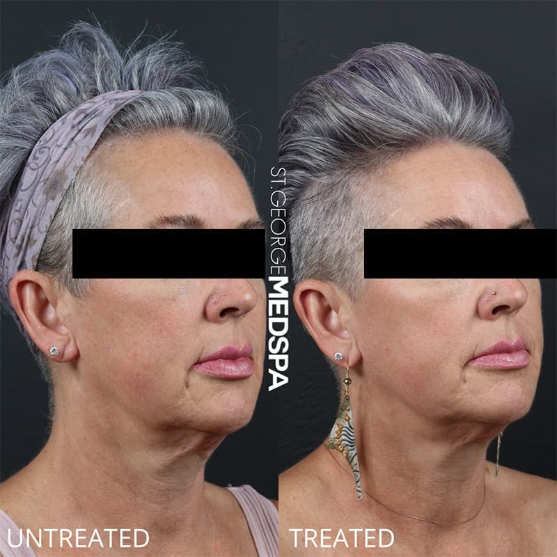 Laser Treatments Before & After Image