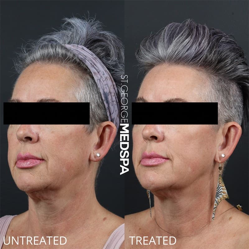 Laser Treatments Before & After Image