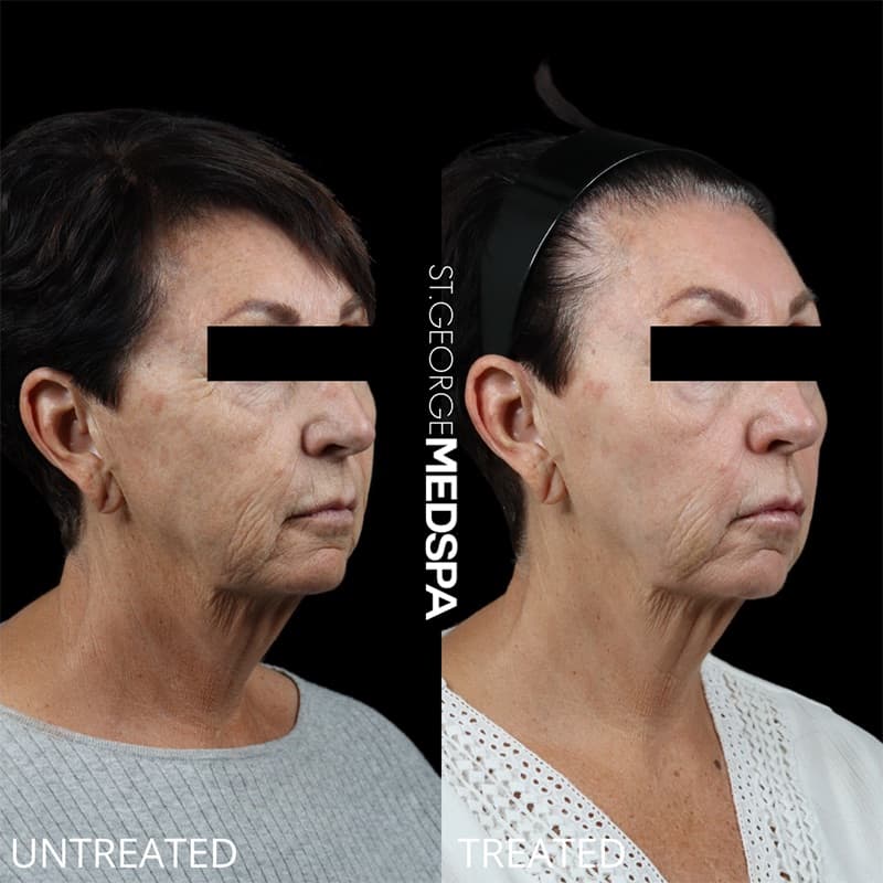 Laser Treatments Before & After Image