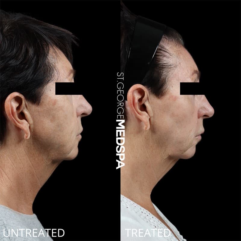 Laser Treatments Before & After Image