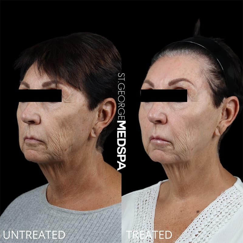 Laser Treatments Before & After Image