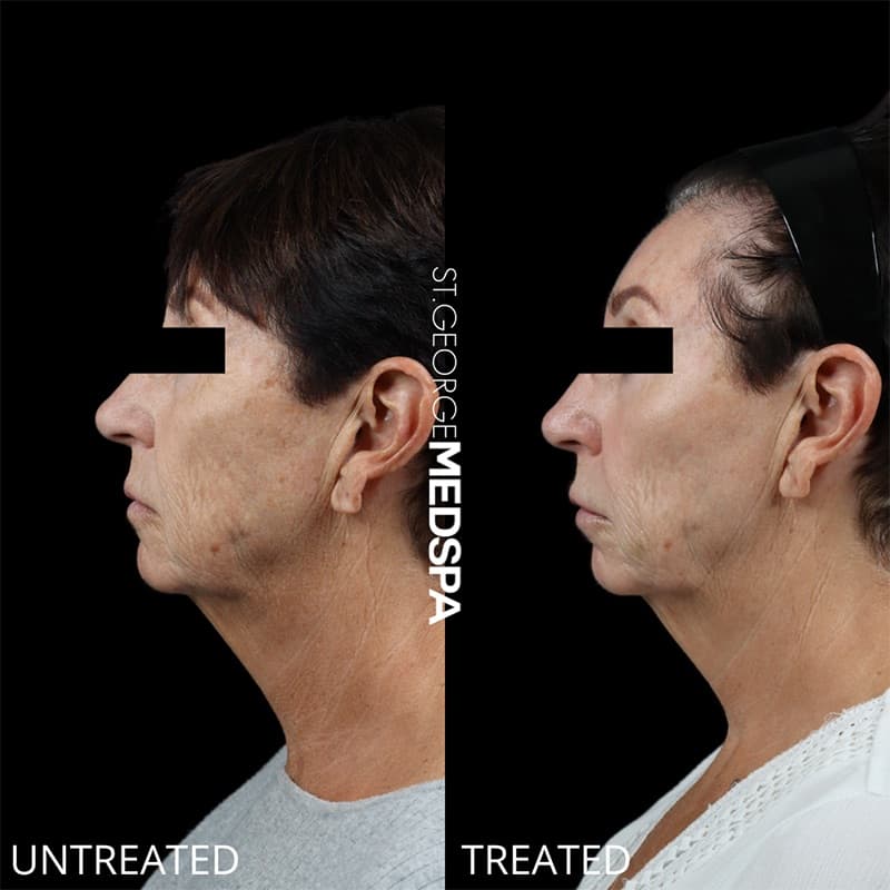 Laser Treatments Before & After Image