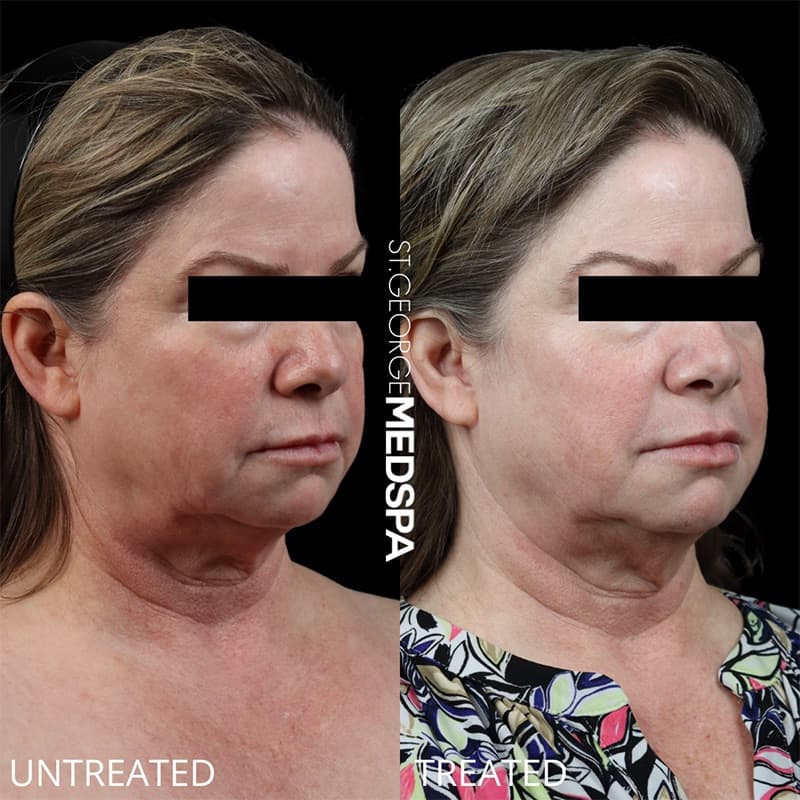 Laser Treatments Before & After Image