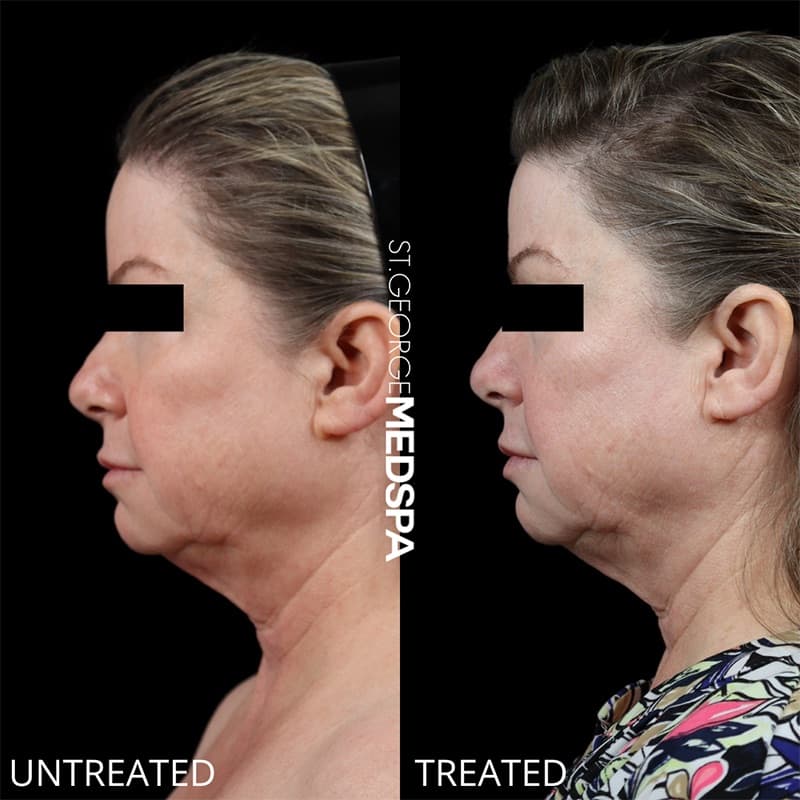 Laser Treatments Before & After Image