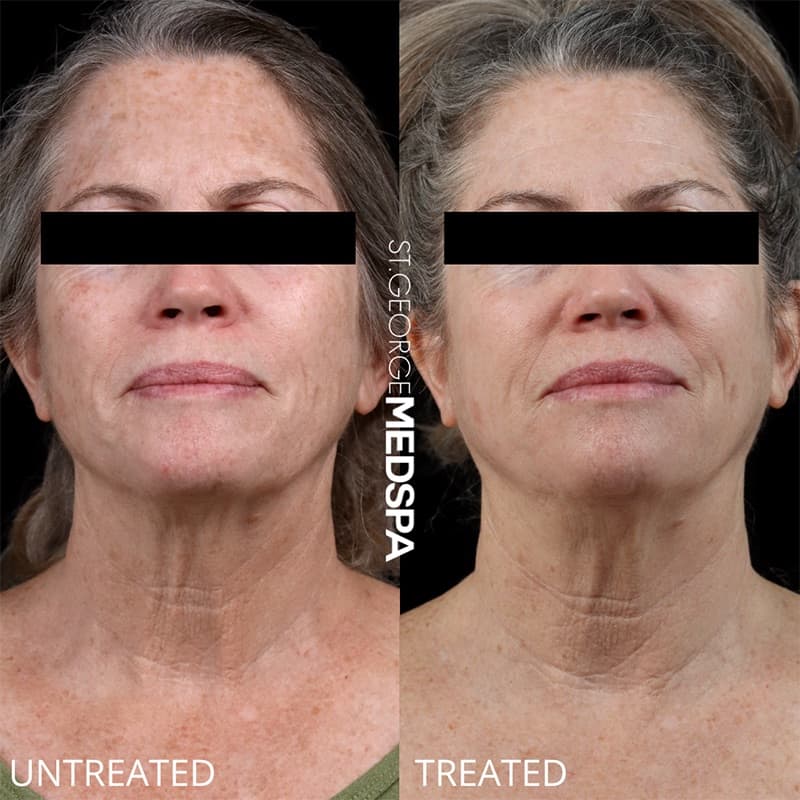 Laser Treatments Before & After Image