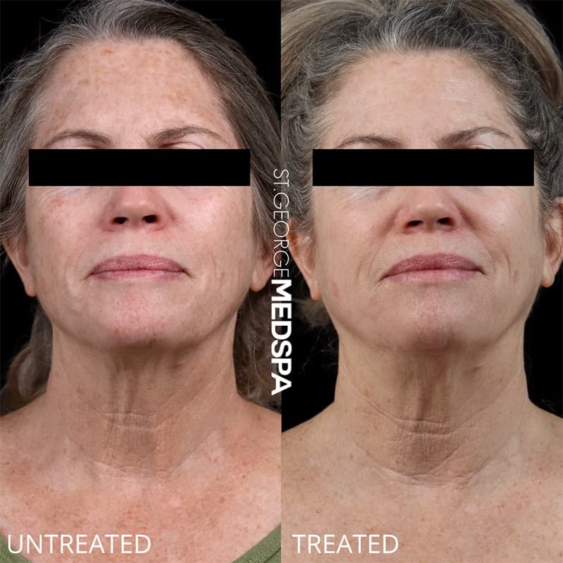 Laser Treatments Before & After Image