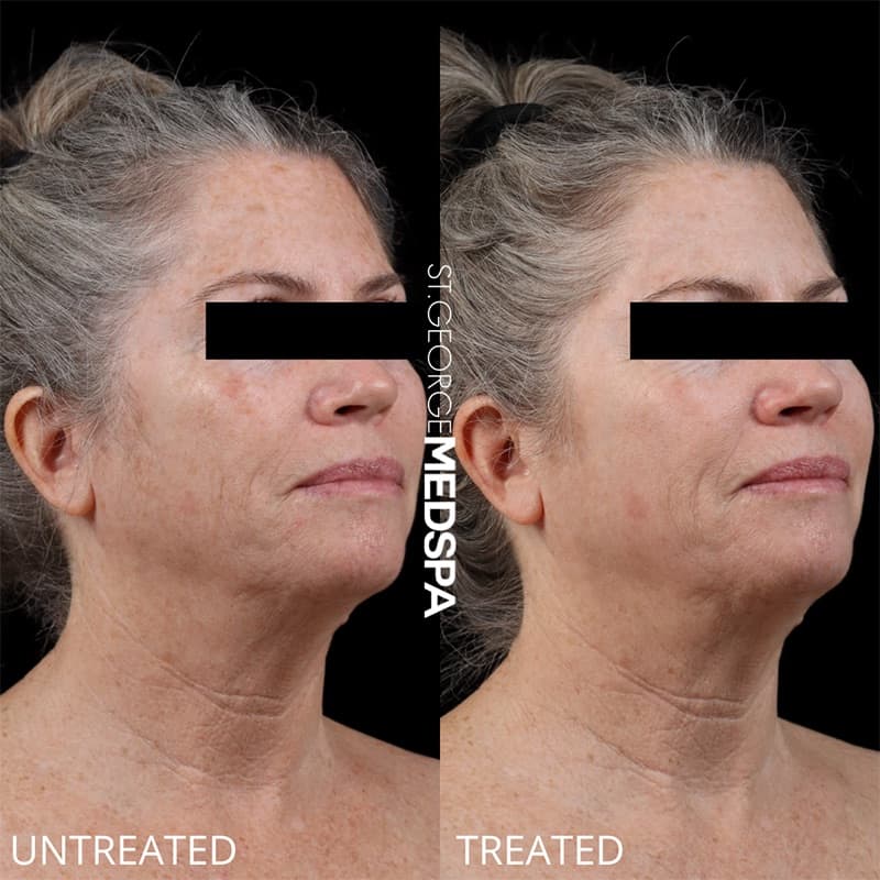 Laser Treatments Before & After Image