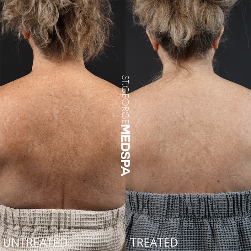 Laser Treatments Before & After Image