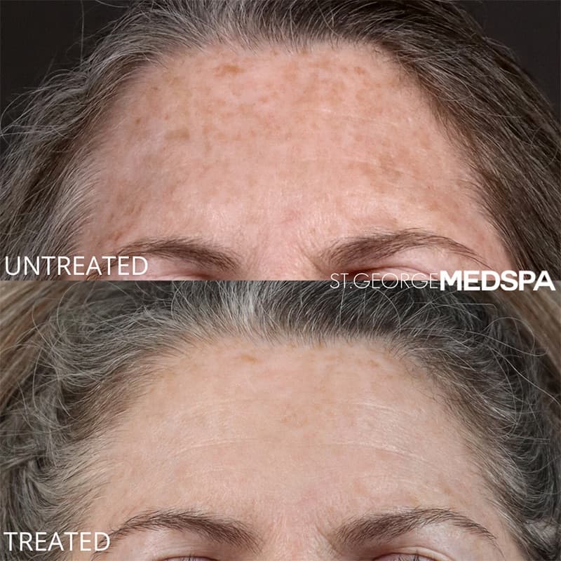 Laser Treatments Before & After Image