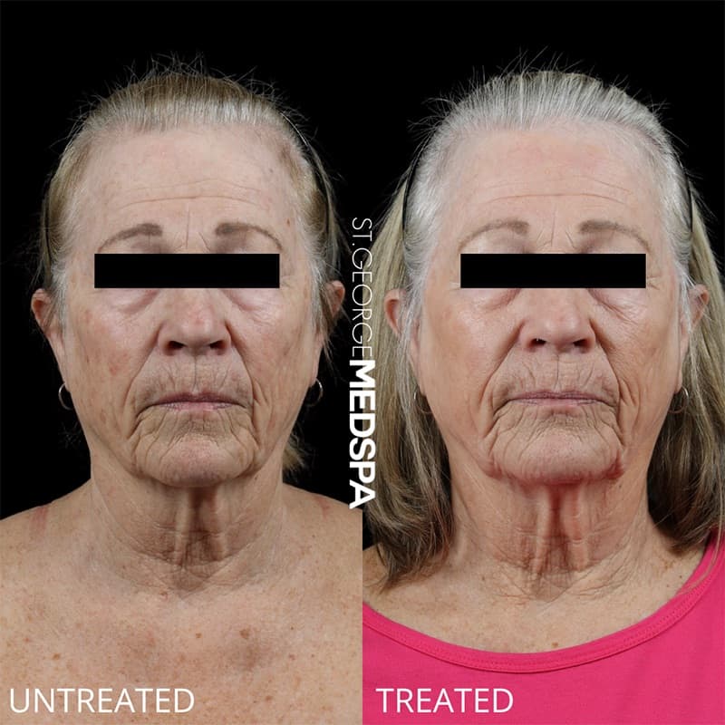 Laser Treatments Before & After Image