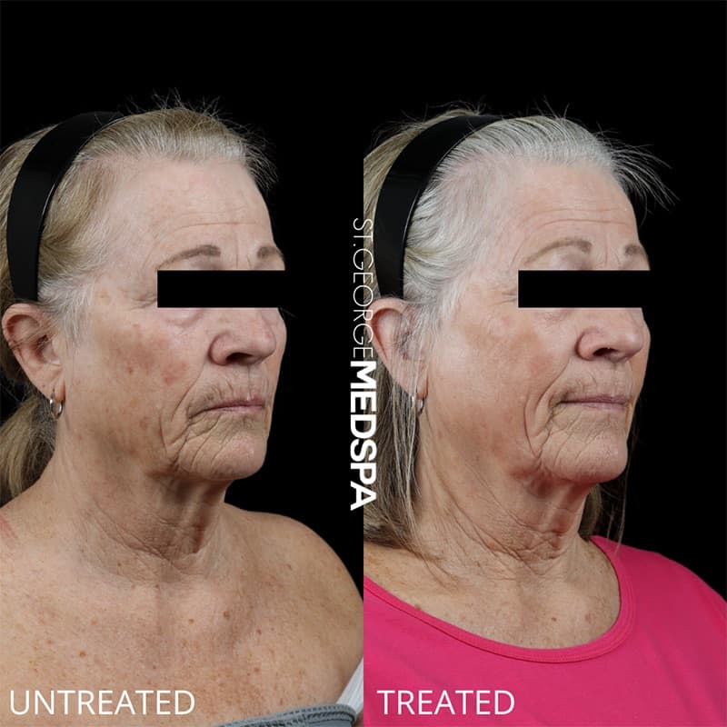 Laser Treatments Before & After Image