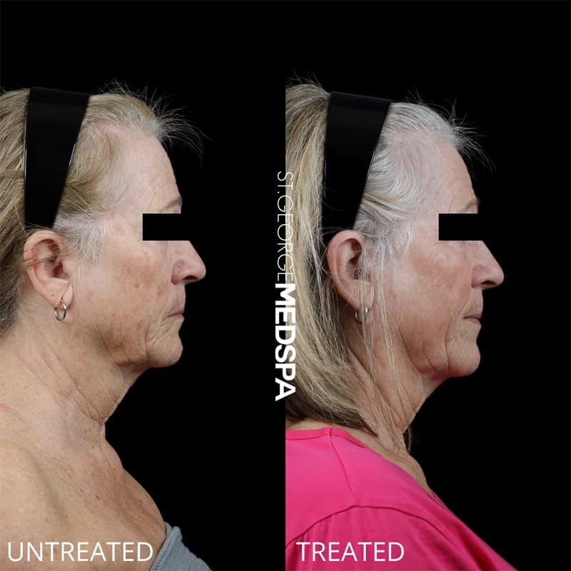 Laser Treatments Before & After Image