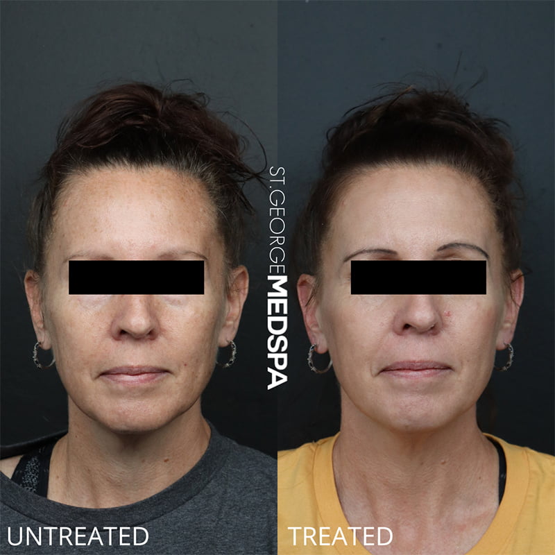 Laser Treatments Before & After Image