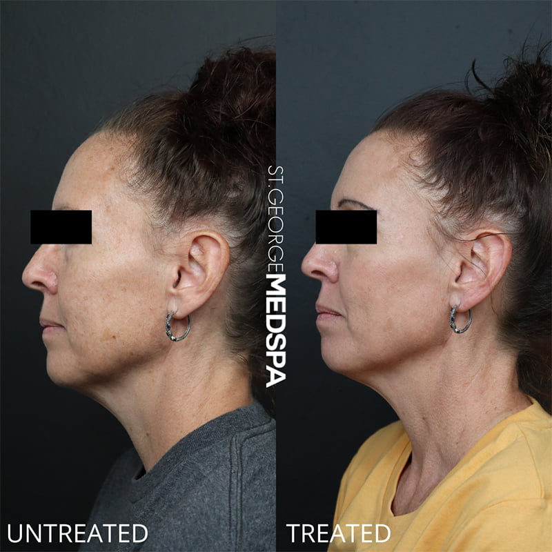 Laser Treatments Before & After Image