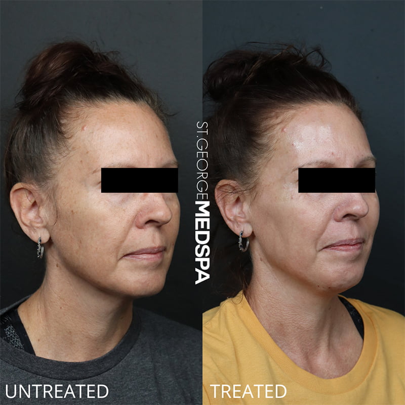 Laser Treatments Before & After Image