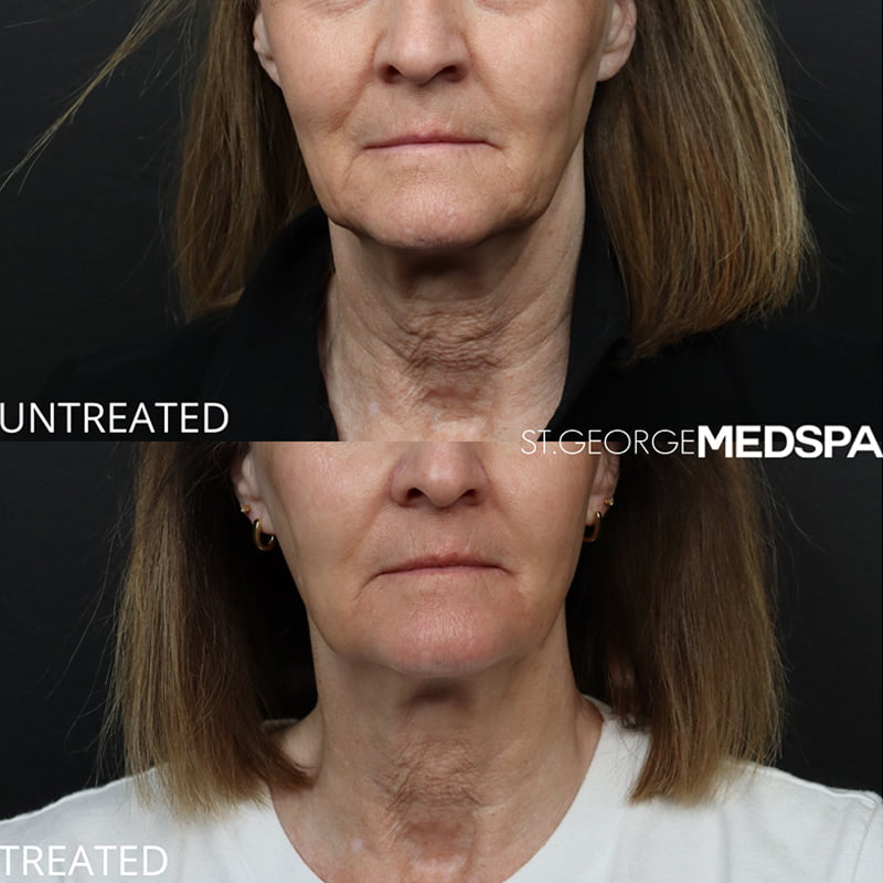 Laser Treatments Before & After Image
