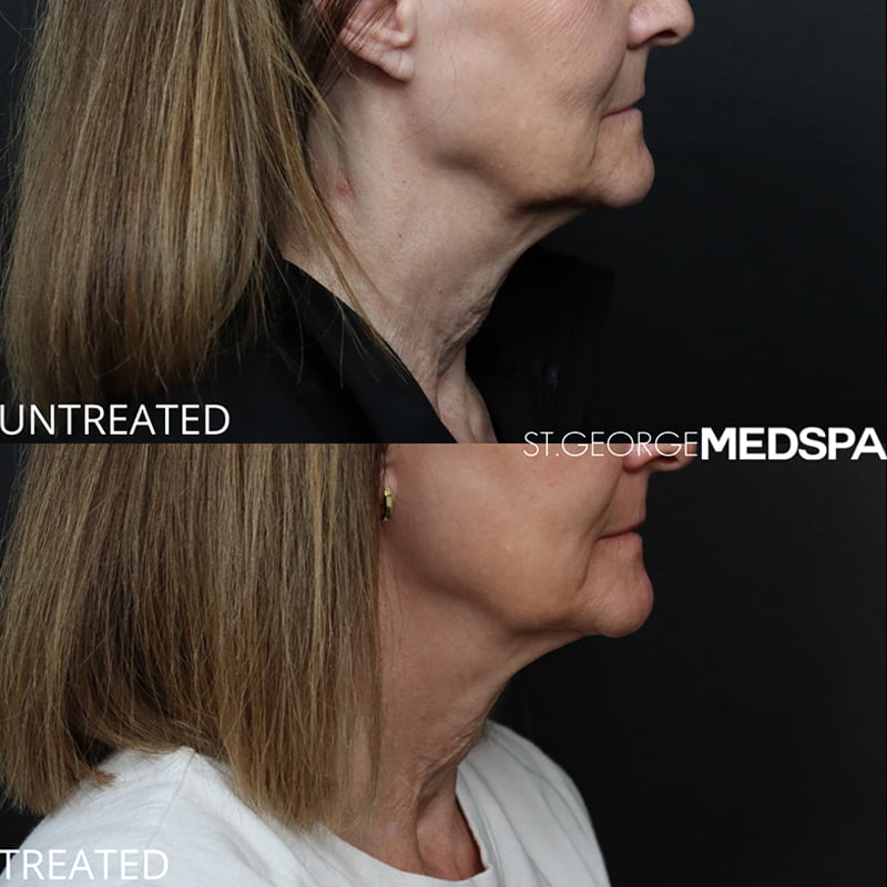 Laser Treatments Before & After Image