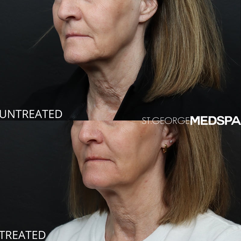 Laser Treatments Before & After Image