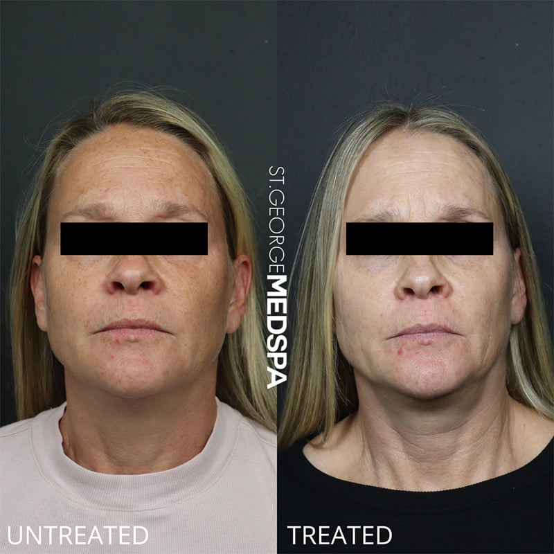 Laser Treatments Before & After Image