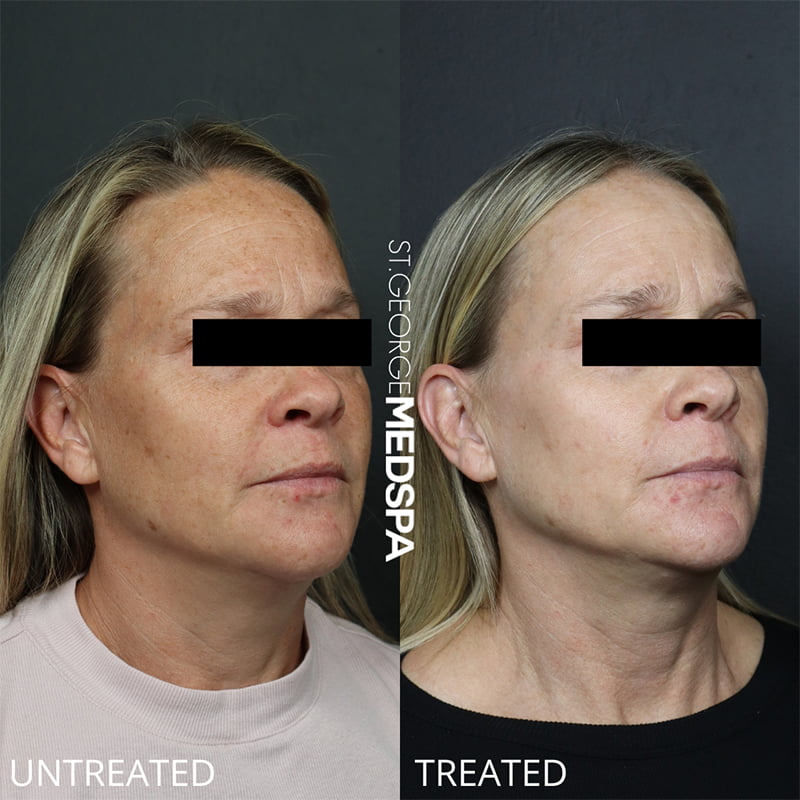 Laser Treatments Before & After Image