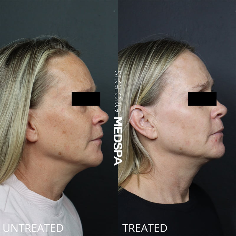 Laser Treatments Before & After Image