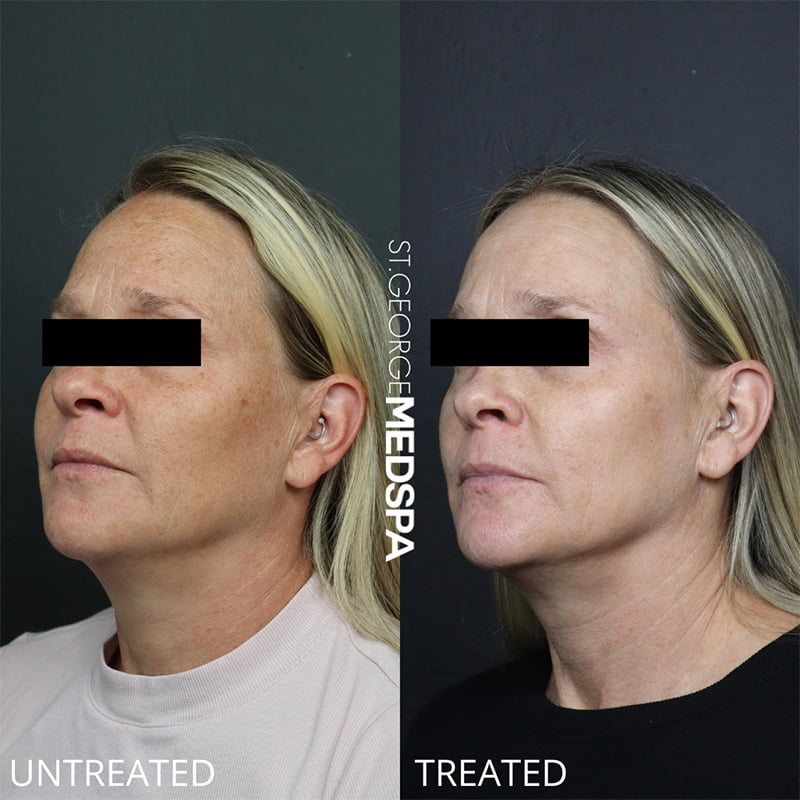 Laser Treatments Before & After Image