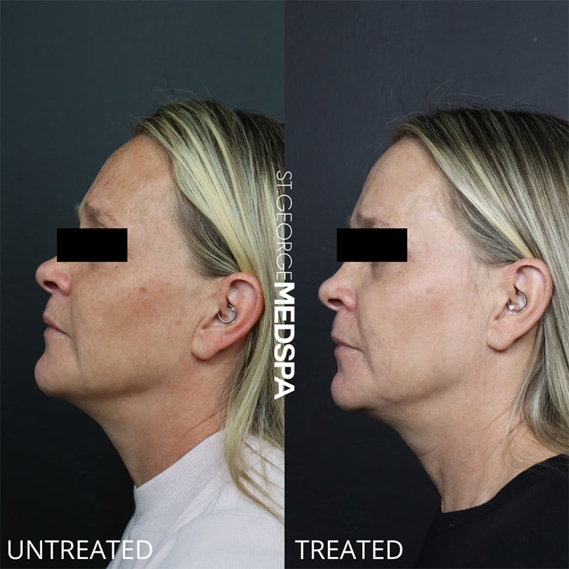 Laser Treatments Before & After Image