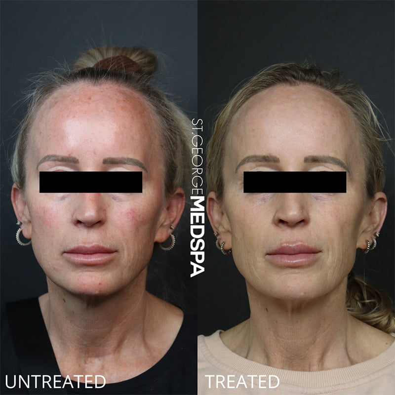 Laser Treatments Before & After Image