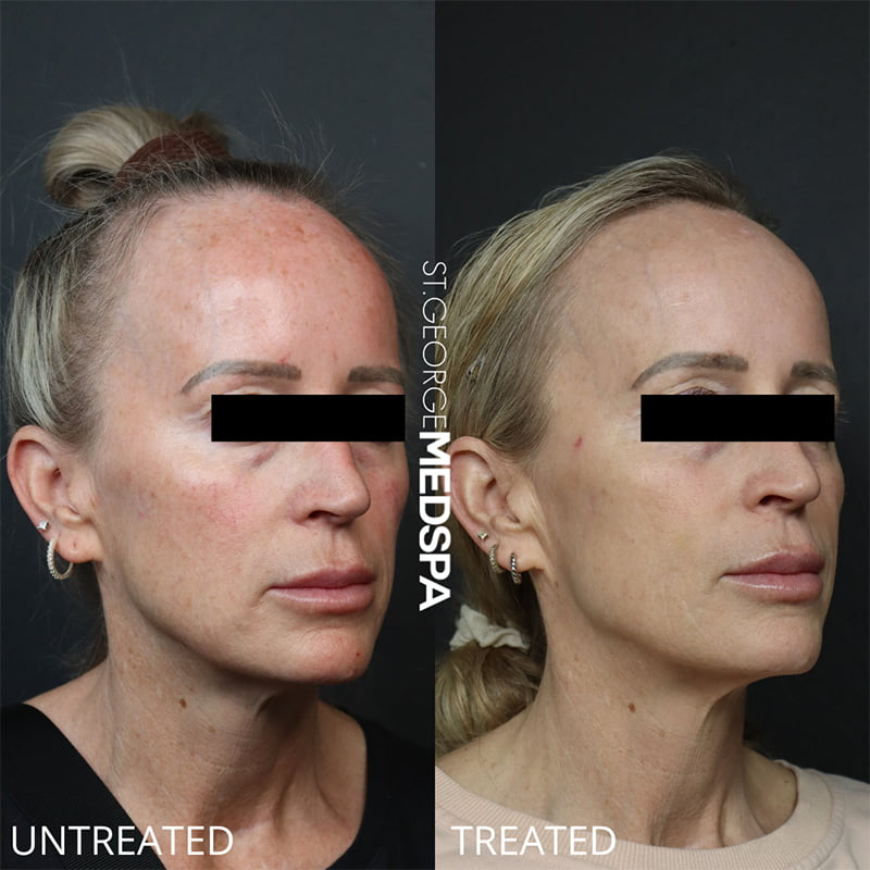 Laser Treatments Before & After Image