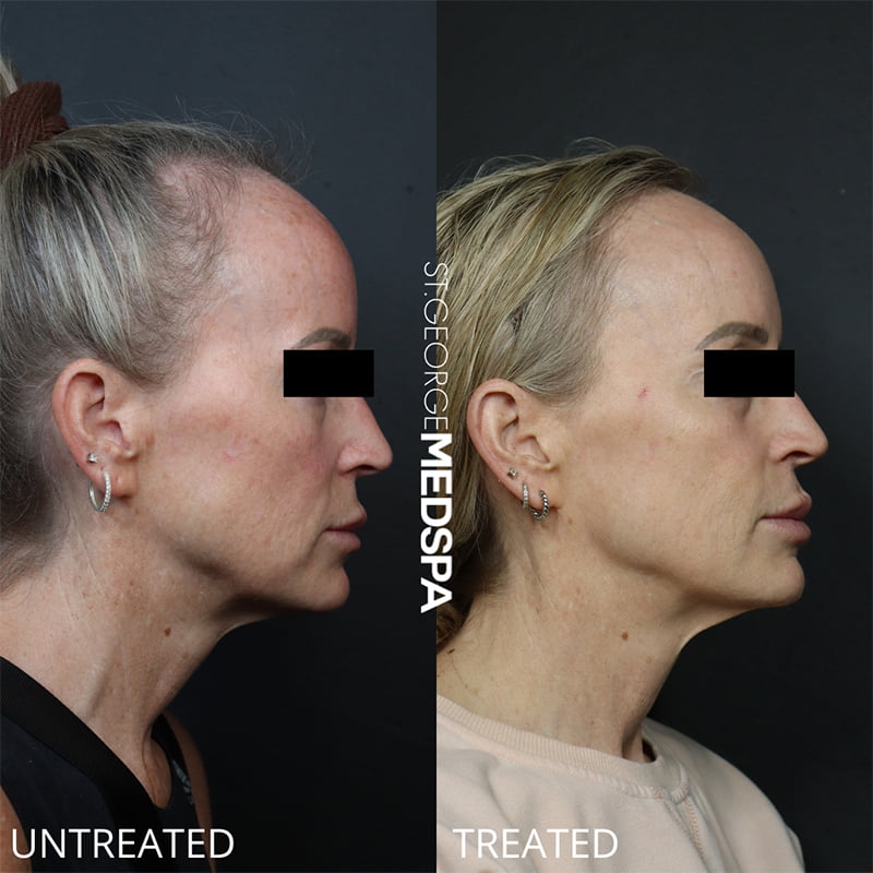 Laser Treatments Before & After Image