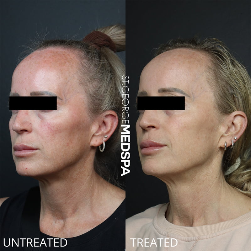 Laser Treatments Before & After Image