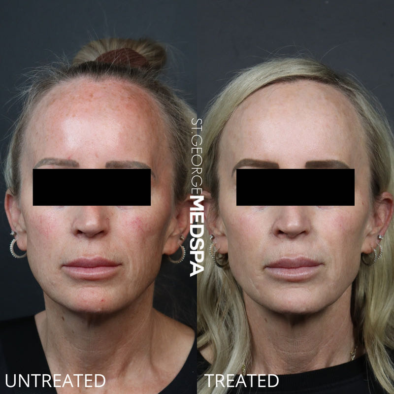 Pigment Correction Before & After Image