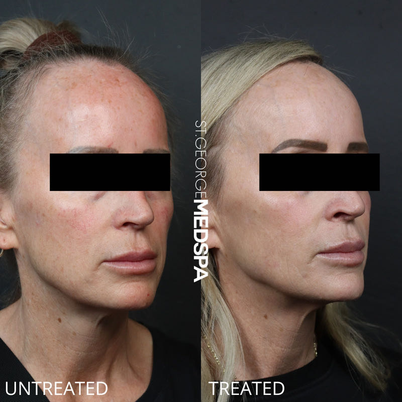 Pigment Correction Before & After Image