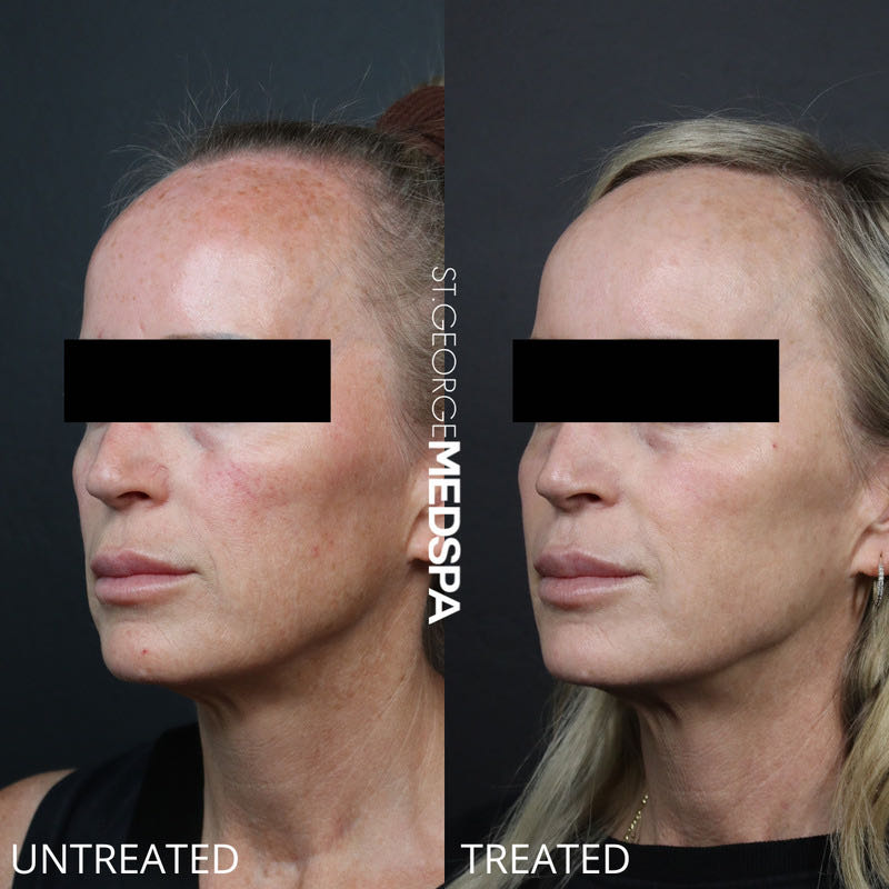 Pigment Correction Before & After Image