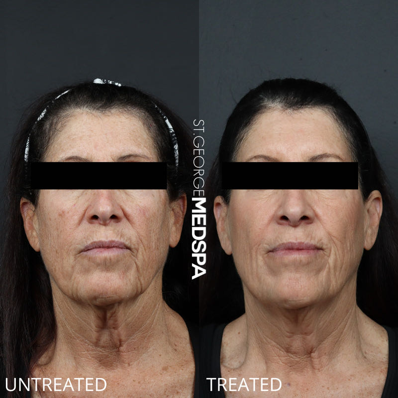 Pigment Correction Before & After Image