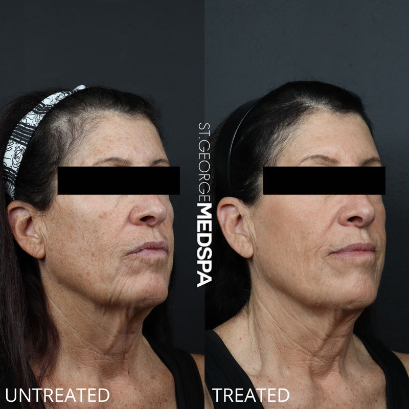 Pigment Correction Before & After Image