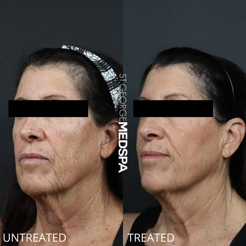Pigment Correction Before & After Image